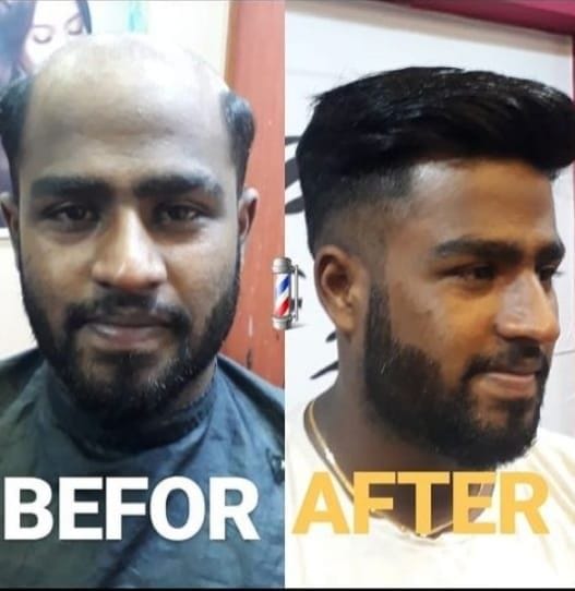 Confident clients after hair replacement at GetHair Chennai
